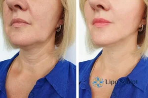 Double chin before and after Hi-Fu treatment 4 Book your double chin treatment Bexleyhill today! We are here to help!