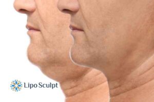 Double chin before and after Hi-Fu treatment 2 Double chin treatment Bexleyhill from Lipo Sculpt - feel more confident today!