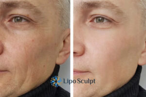How to Fight Aging Symptoms 3 Fight Aging Symptoms Bexleyhill With HIFU and Morpheus8 Today!