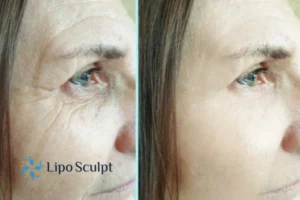 How to Fight Aging Symptoms 2 Do you want to Fight Aging Symptoms Bexleyhill? Contact Lipo Sculpt today!