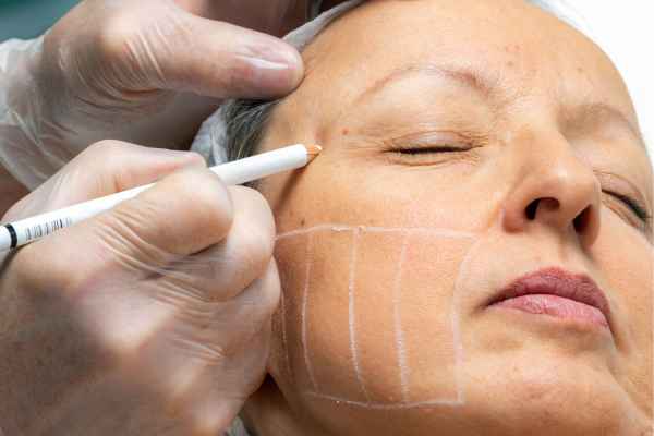 CryoPen: 5 Skin Concerns It May Be Used to Treat 4 What should you ask before having CryoPen treatment Bexleyhill?