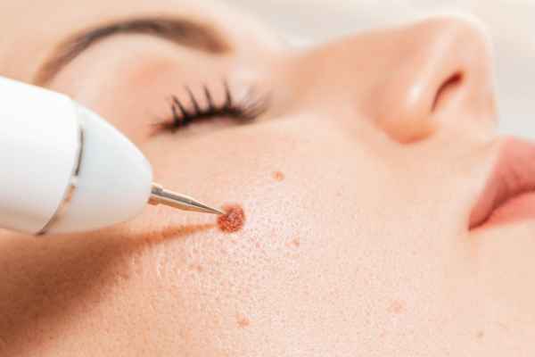 CryoPen: 5 Skin Concerns It May Be Used to Treat 3 What actually happens during a CryoPen treatment Bexleyhill?