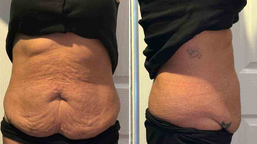Lost the Weight but Not the Loose Skin? What You Should Know 1 Is It Definitely Loose Skin Bexleyhill?